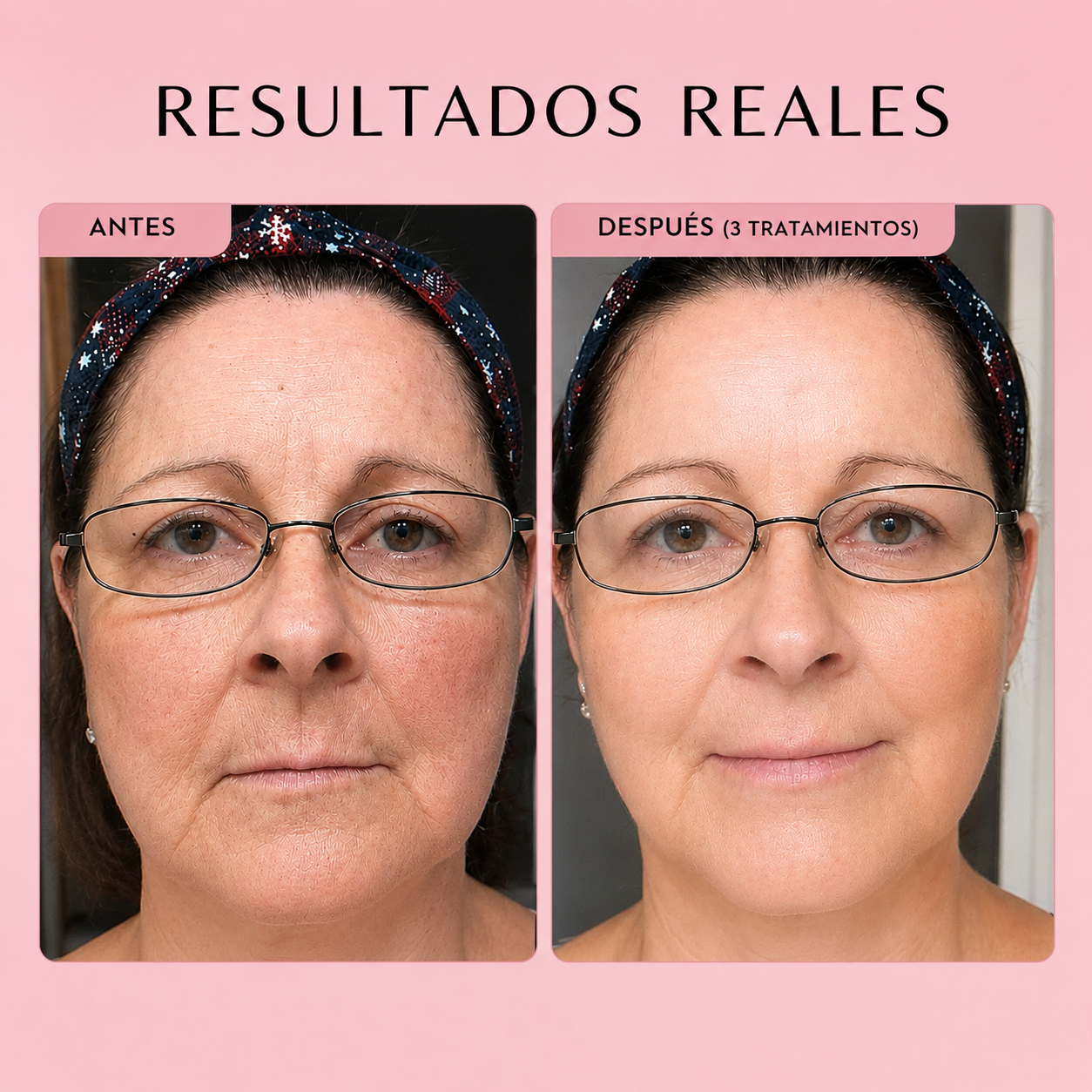 DermaGlow™ - Microneeding con serum integrado